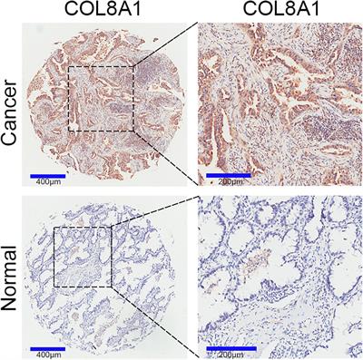 COL8A1 Promotes NSCLC Progression Through IFIT1/IFIT3-Mediated EGFR Activation